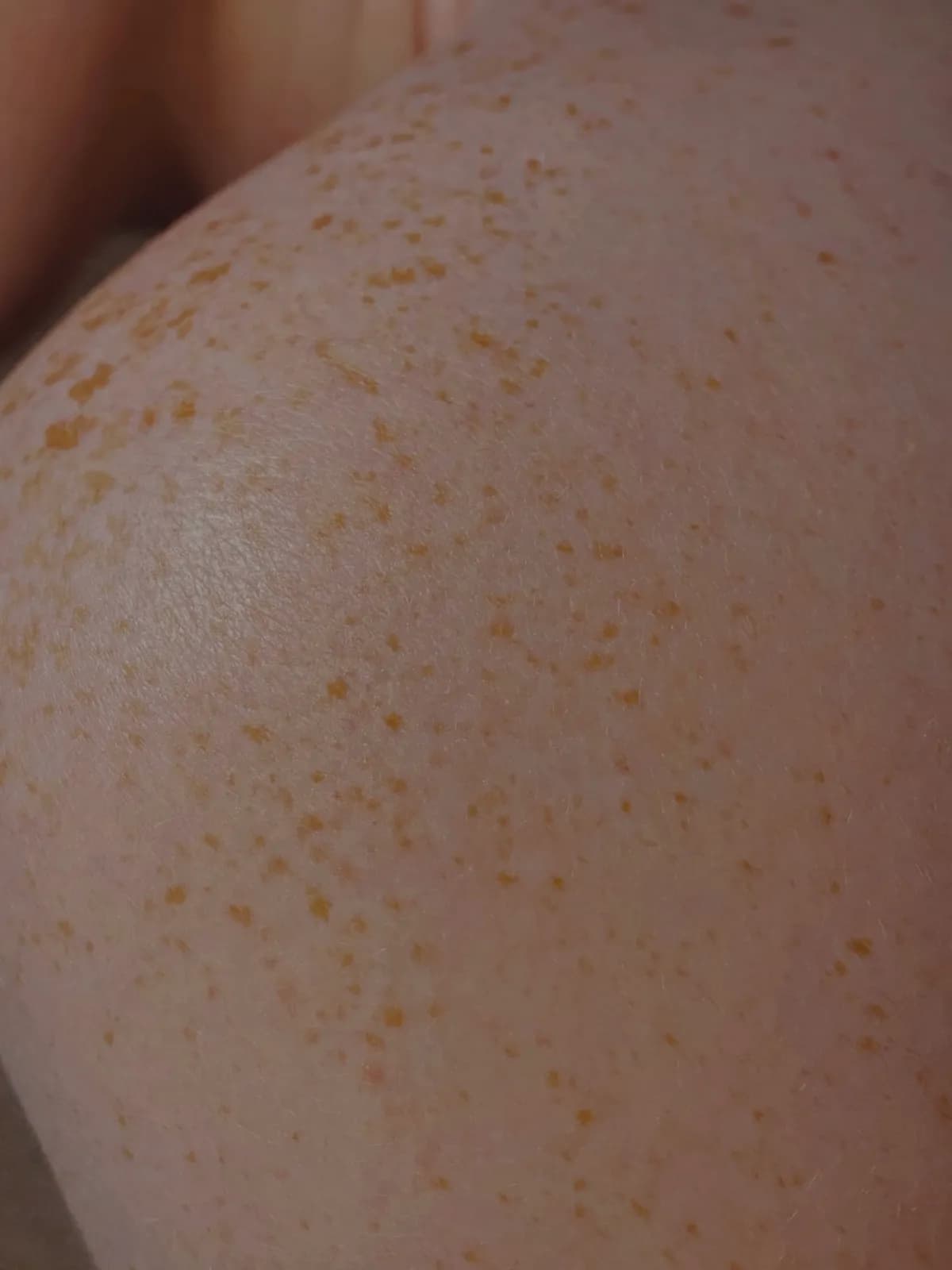 A close up of a persons skin with freckles